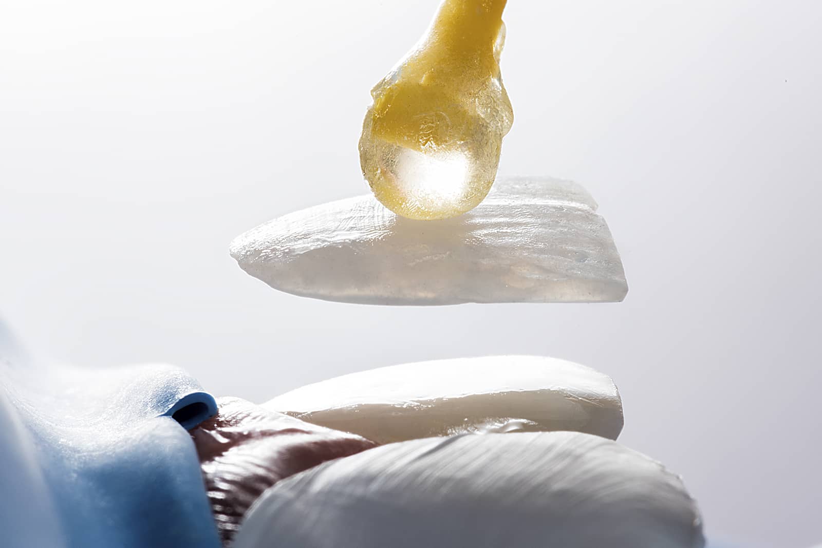 易微笑复合树脂贴面